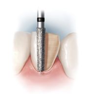 NTI® Guide Pin Diamonds 